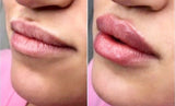 lip injection filler hyaluronic acid training class